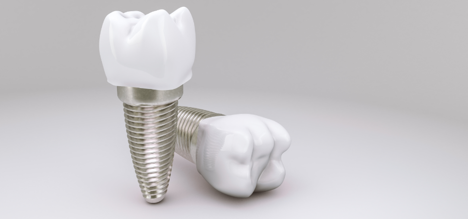 임플란트
