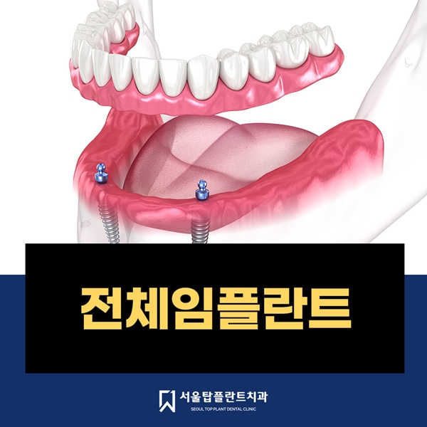 전체임플란트 서울탑플란트치과에서 진료받으세요